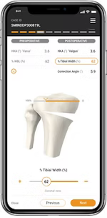 osteotomy Digitale Planung osteotomy Digitale Planung